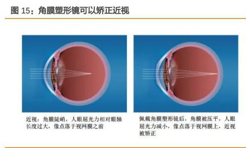 爱博医疗专题报告 创新引领,开启明眸视界